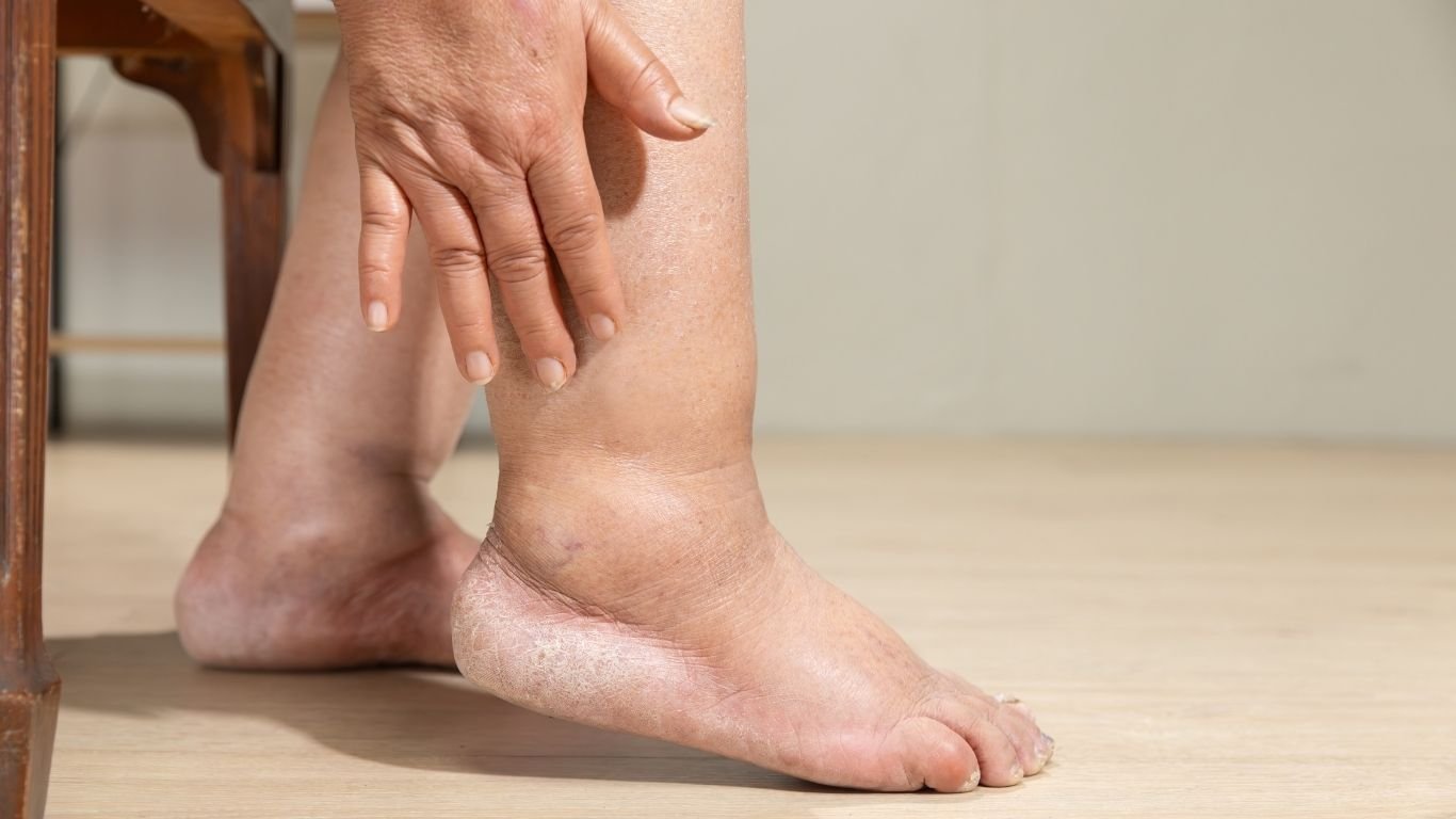 Woman touching a visibly swollen ankle